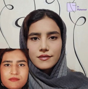 جراحی-بینی-12