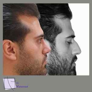 جراحی-بینی-13