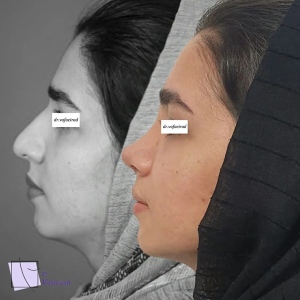 جراحی-بینی-3