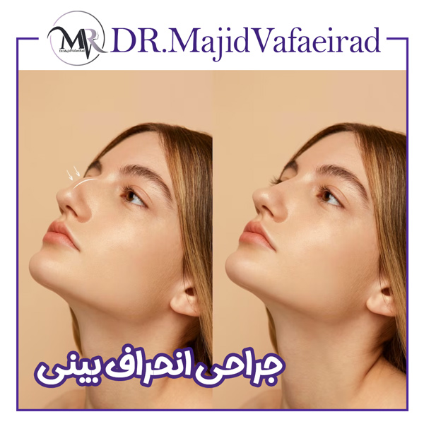 جراحی انحراف بینی - دکتر مجید وفایی راد