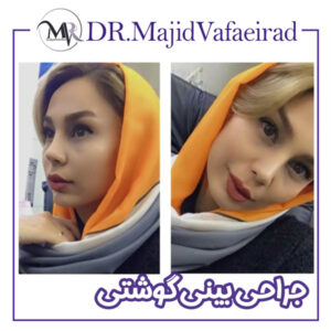 جراحی بینی گوشتی - دکتر مجید وفایی راد