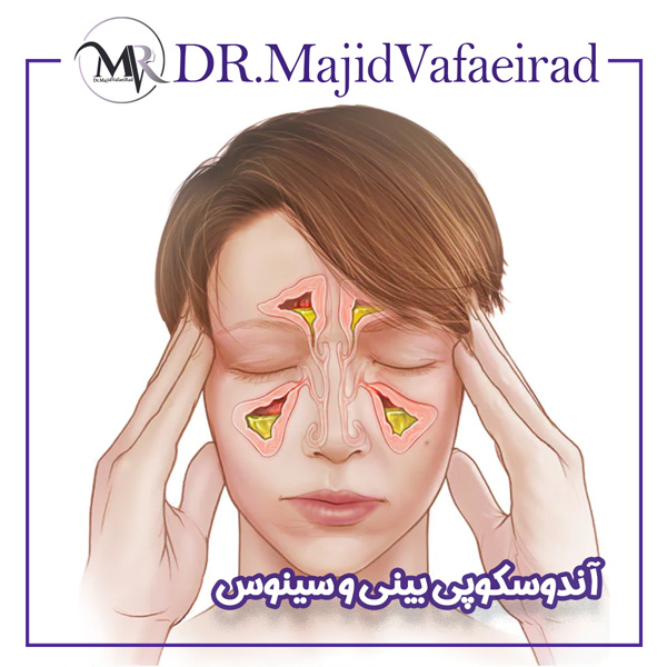 آندوسکوپی بینی و سینوس - دکتر مجید وفایی راد