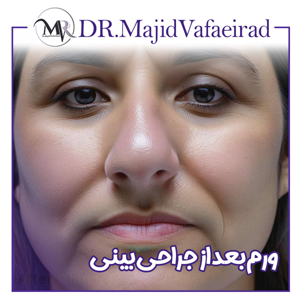 ورم بینی بعد از جراحی - دکتر مجید وفایی راد