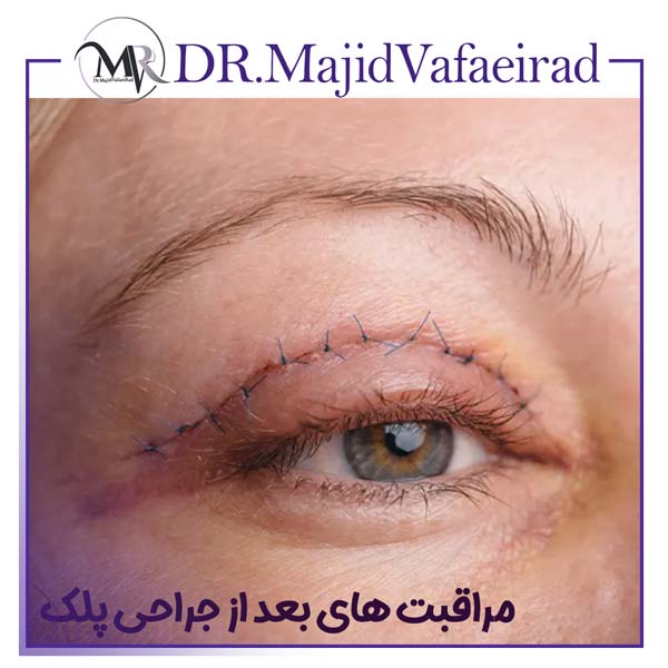 مراقبت های بعد از جراحی پلک