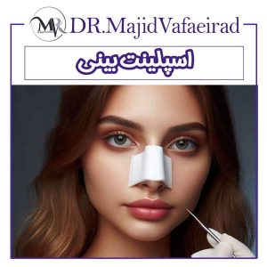 اسپلینت بینی