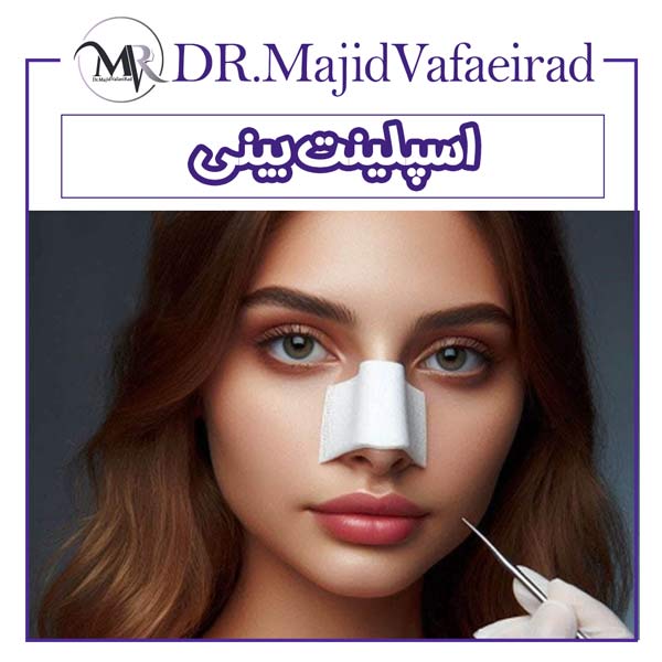 اسپلینت بینی