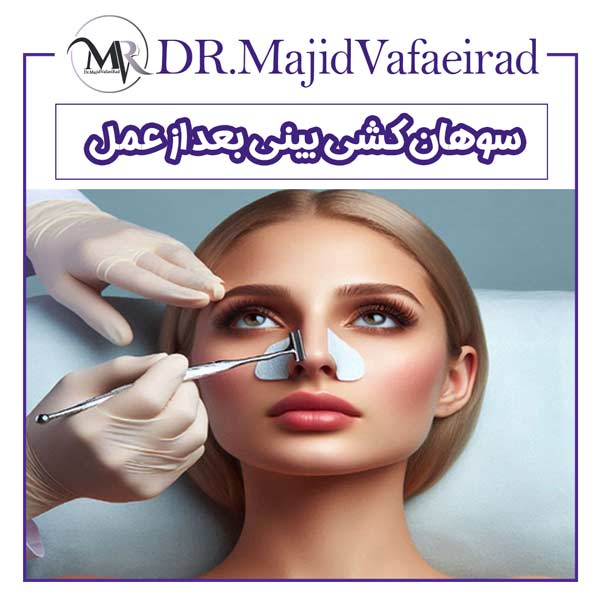 سوهان کشی بینی بعد از عمل