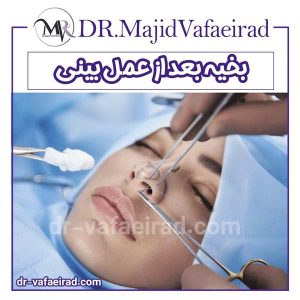 بخیه بعد از عمل بینی - دکتر محید وفایی راد - بهترین جراح بینی همدان