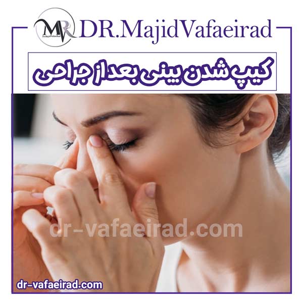 کیپ شدن بینی بعد از جراحی - دکتر مجید وفایی راد
