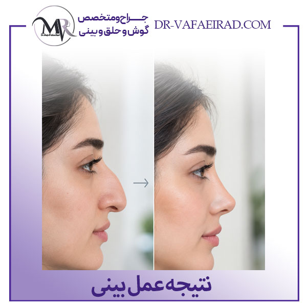 نتیجه جراحی بینی + دکتر مجید وفایی راد
